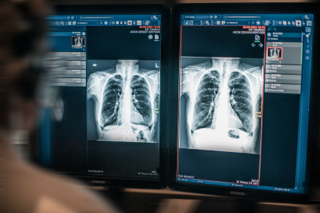 CT thorax